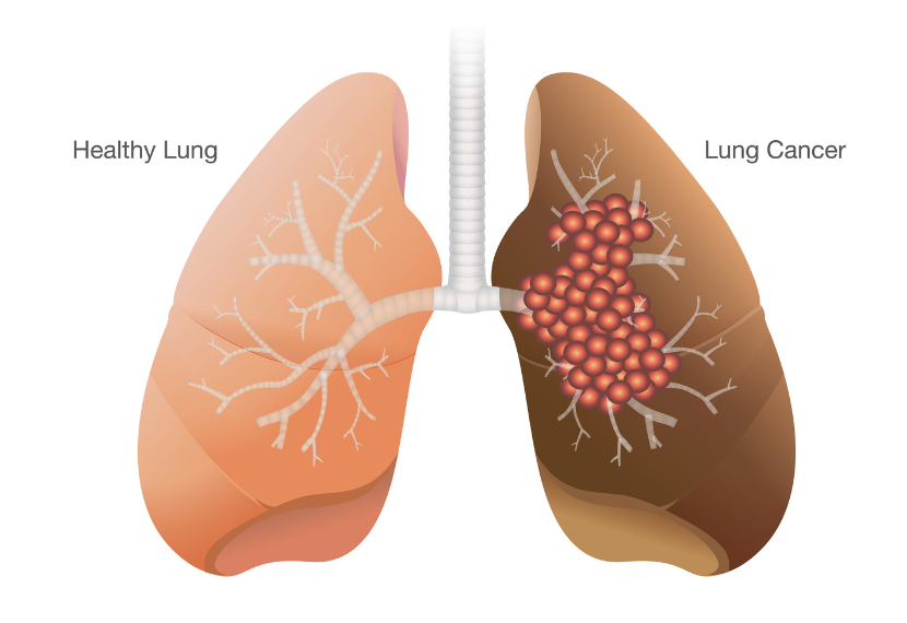 lung-cancer-signs